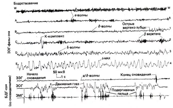 Ээг бодрствования. ЭЭГ эпилепсия пик-волна. Острая волна медленная волна на ЭЭГ. Комплекс острая медленная волна на ЭЭГ. Спайк волна на ЭЭГ.