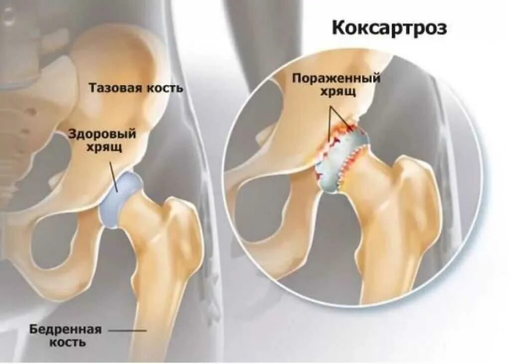 Коксартроз тазобедренного сустава лечение что это. Хрящ тазобедренного сустава. тазобедренный сустав сустав. суставный хрящ в тазобедренном суставе. коксартроз тазобедренного сустава.
