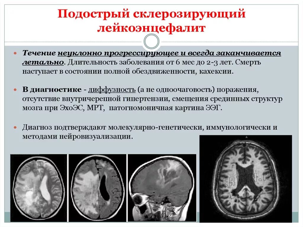 Лейкоэнцефалит. Лейкоэнцефалит ван богарта. подострый склерозирующий панэнцефалит ван-богарта. подострый склерозирующий панэнцефалит мрт. подострый склерозирующий лейкоэнцефалит.