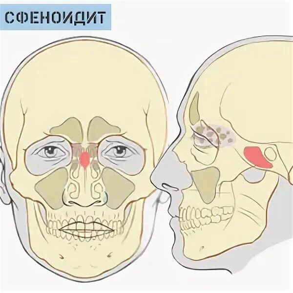 Сфеноидит операция. Сфеноидит воспаление клиновидной пазухи. Катаральный сфеноидит. Свиноидальные пазуъхи.