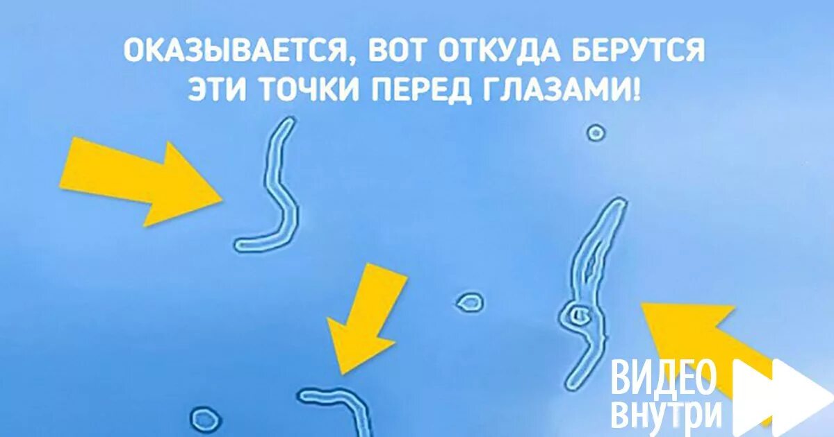 Плавает перед глазами. Плавающие мушки перед глазами. Плавающие точки перед глазами. Пятна перед глазами.