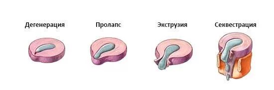 Протрузия экструзия секвестрация. Пролабирование диска позвоночника что это. Пролапс межпозвоночного диска в поясничном отделе. Протрузия экструзия грыжа.