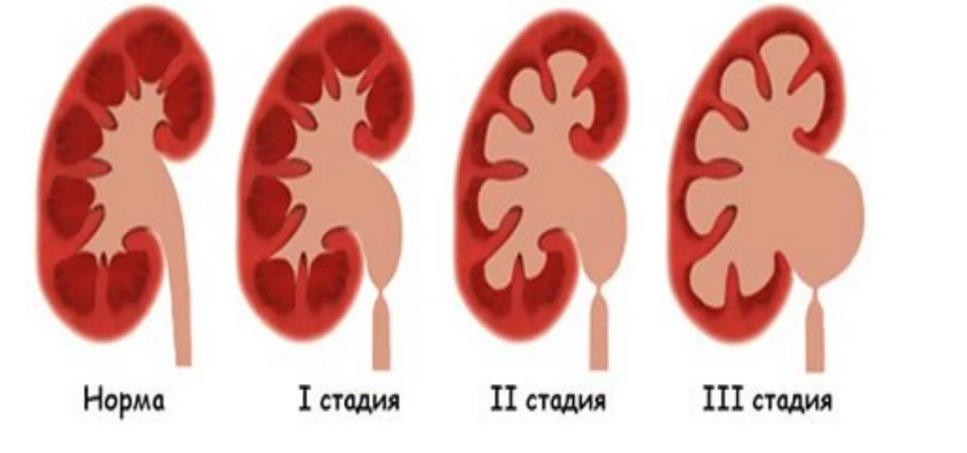 Что значит лоханка расширена. Расширение лоханки гидронефроз. Пиелоэктазия гидронефроз почек. Внутрипочечная лоханка.