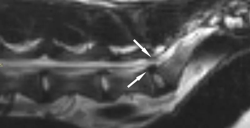 Стеноз у собак. Люмбосакральный стеноз. Дегенеративно Люмбо сакральный стеноз. Люмбосакральный стеноз у собак. Люмбально сакральный стеноз у собак.