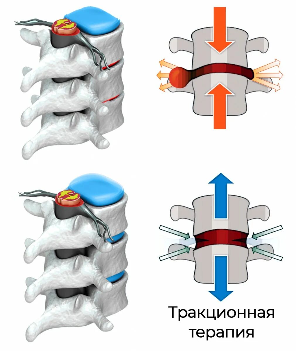 Компрессионный перелом позвоночника вытяжение. Компрессия позвонков. Компрессия межпозвоночных дисков. Межпозвонковые диски сжатие.