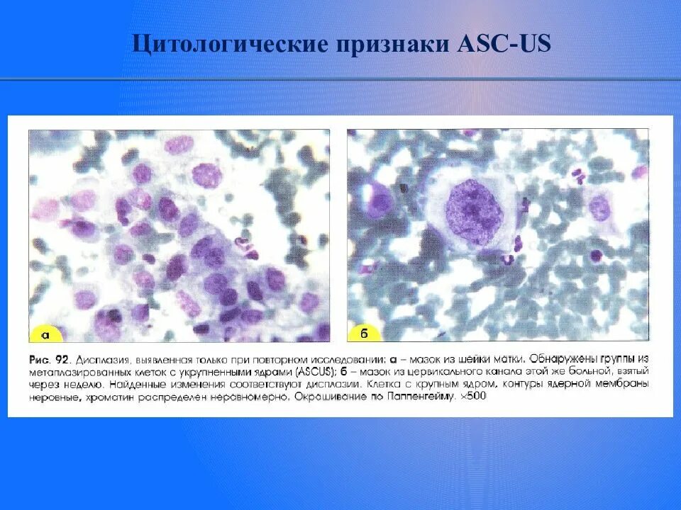 Цитологическая картина пролиферации цилиндрического эпителия. Цитология с признаками пролиферации. Выраженная пролиферация и атипия клеток. Дегенеративные изменения клеток в мазке.