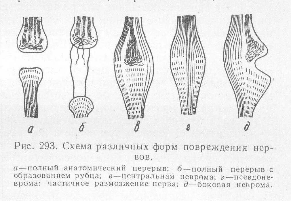 Формы повреждения нерва. Травмы периферических нервов. Классификация повреждения нерва. Классификация повреждений нервов.