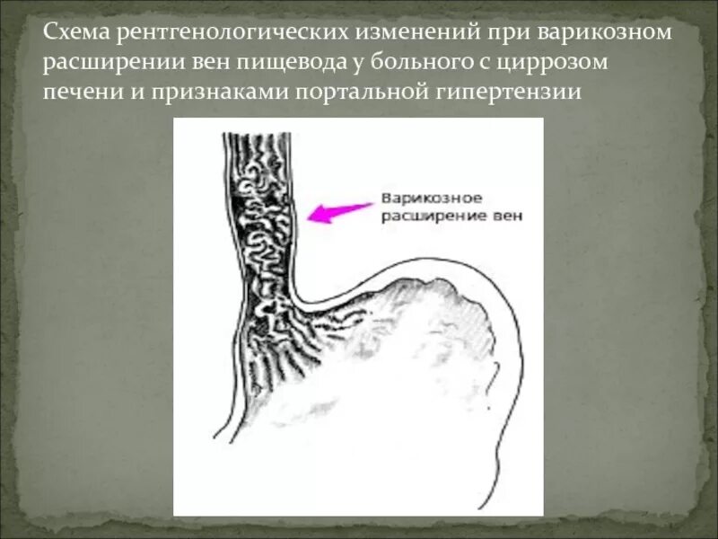 Варикозное расширение вен желудка рентген. Варикозное расширение вен пищевода рентген. Варикозное расширение вен пищевода 3 степени. Варикозное расширение вен пищевода рентгенограмма.