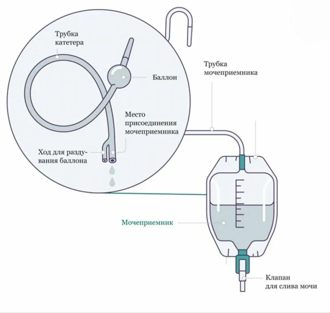 Постоянный мочевой катетер строение. Катетер Фолея схема. Моче приёмник к катетер Фолея. Промывание катетера мочевого пузыря алгоритм. Промывают мочевой пузырь у мужчин