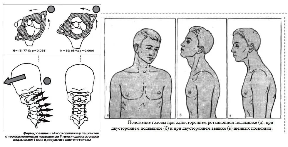 Положение затылка. Ротационный подвывих с1 позвонка. Ротационный подвывих 1 шейного позвонка. Подвывих с1 шейного позвонка.