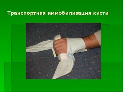 Иммобилизация конечности гипсовой повязкой