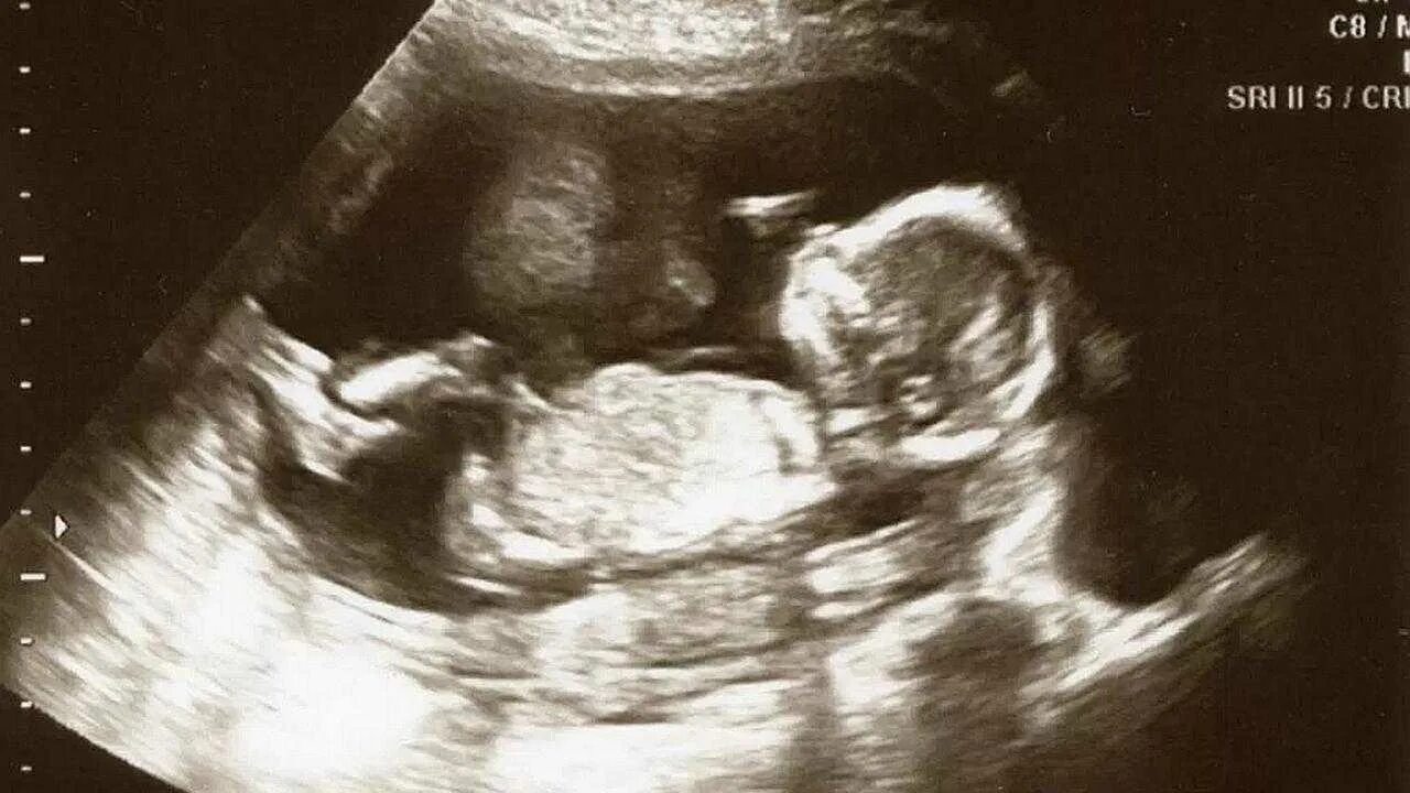 Снимок УЗИ на 16 неделе беременности. Плод 16 недель беременности УЗИ плода. 16 Недель беременности фото ребенка на УЗИ. УЗИ 16 недель беременности УЗИ. 16 недель 3 5