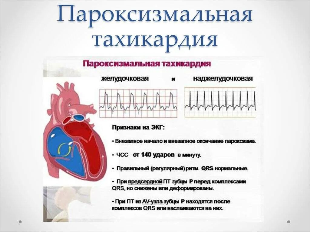 Пароксизм желудочковой тахикардии ЭКГ. Пароксизмальная тахикардия ЭКГ диагностика. ЭКГ критерии пароксизмальной суправентрикулярной тахикардии. Пароксизмальная тахикардия у детей ЭКГ. Признаки тахикардия у женщины симптомы