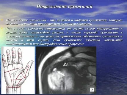 Разрыв сухожилий мизинца