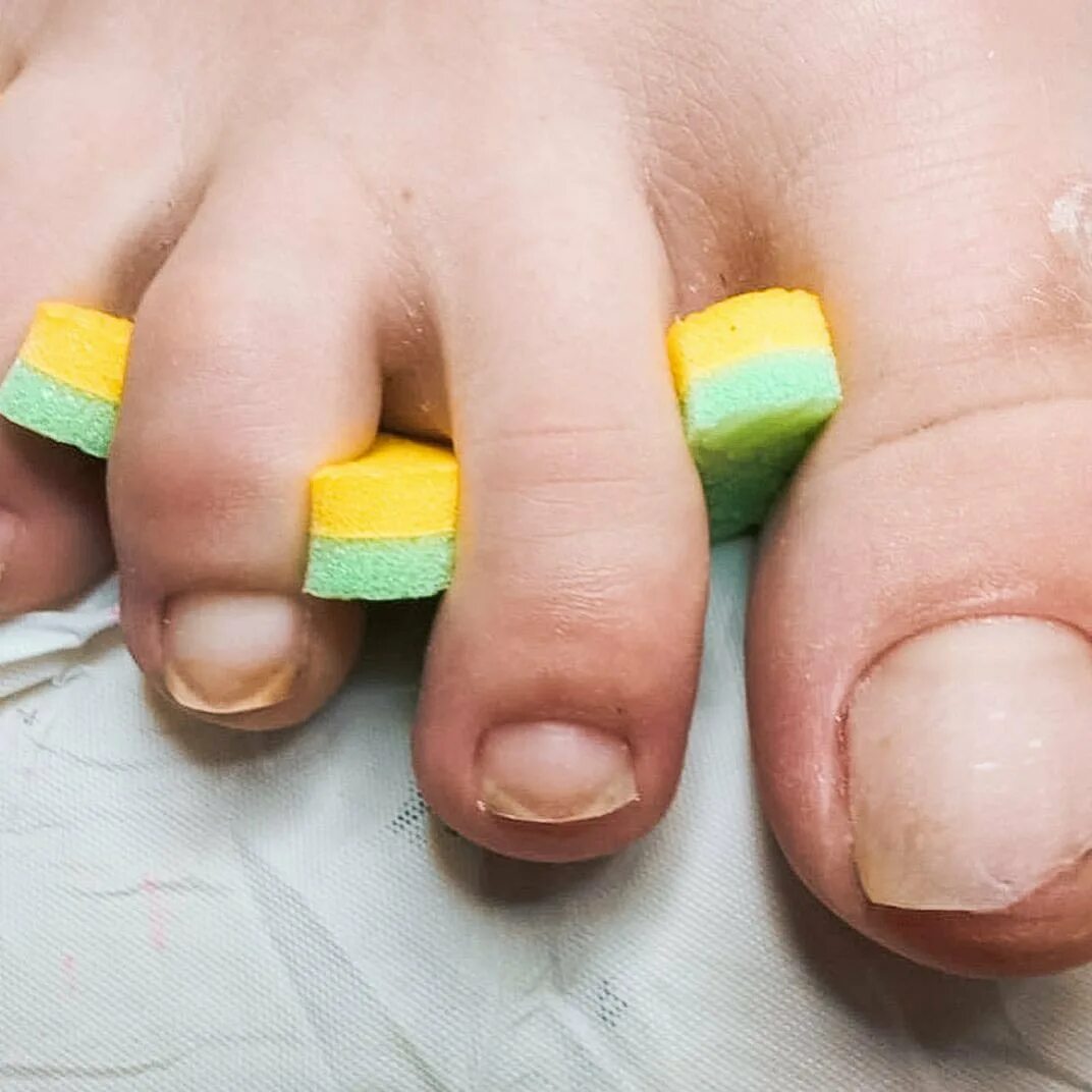Жёлтые ногти на ногах грибок.