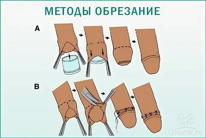 Натерта крайняя плоть
