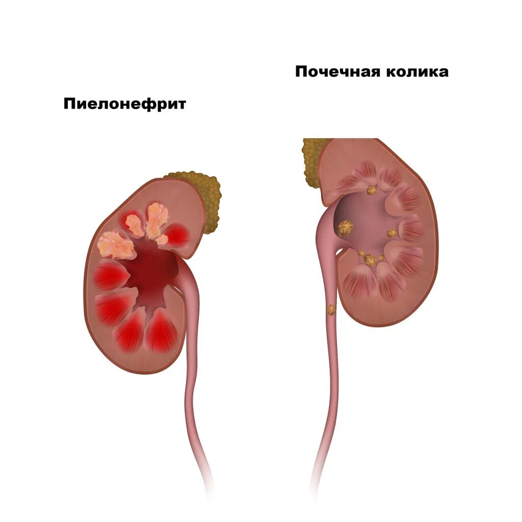 Мочекаменные колики. Почечная колика. Колики в почках симптомы. Мочекаменная болезнь почечная колика. Пиелонефрит и почечная колика.