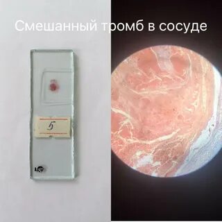 Микропрепарат смешанный тромб в сосуде