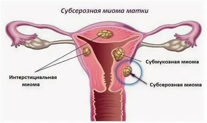 Миома тела матки что это