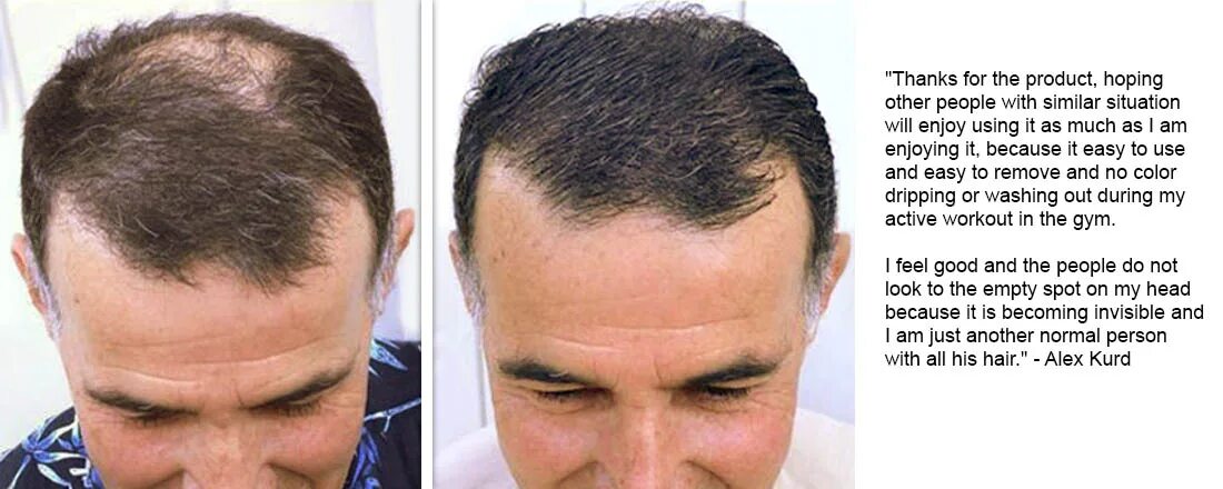 Пудра для лысины. Татуировки маскирующие лысину. Трихопигментация фото андрей афанасьев. Трихопигментация очаговая алопеция. Лысина трихопигментация.