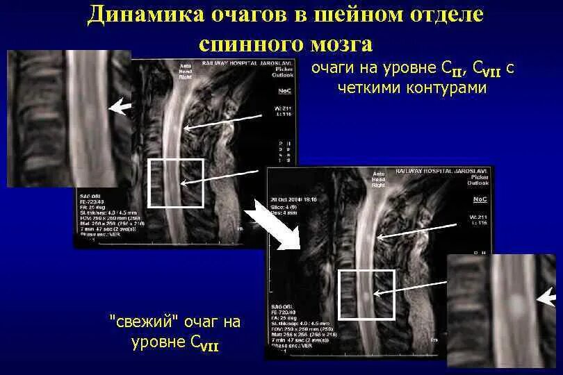 Рассеянный склероз спинного мозга. Рассеянный склероз на мрт позвоночника. Рассеянный склероз шейного отдела. Мрт шейный отдел позвоночника рассеянный склероз. Рассеянный склероз шейного отдела.