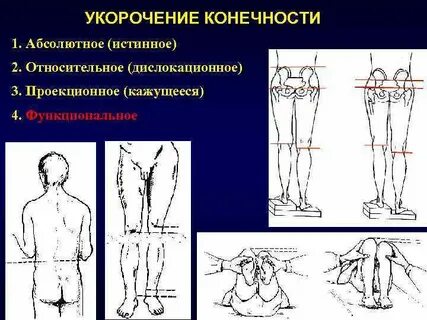 Укорочение правой конечности