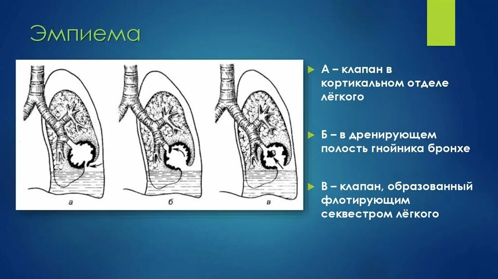 Стадии развития легких. Эмпиема плевральной полости. Кортикальные отделы легких. Кортикальный отдел легкого.