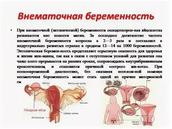 Признаки внематочной на 6 неделе