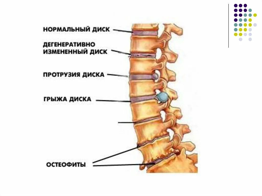 Протрузия дисков шейного отдела лечение. Протрузия дисков шейного отдела лечение