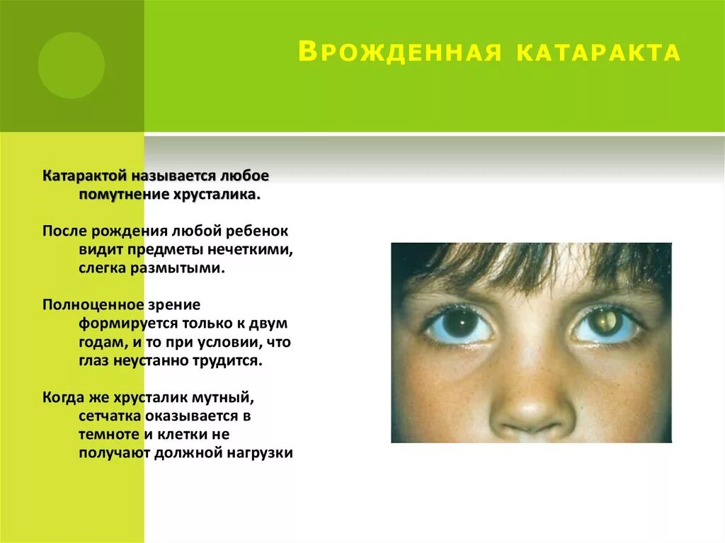 Врожденная катаракта у детей. Причины врожденной катаракты. Врожденная катаракта симптомы.