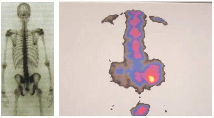 Повышенное накопление РФП В костях. Диффузно неравномерное накопление РФП. РФП. Отмечается повышенное неравномерное накопление РФП. Рфп при пэт кт