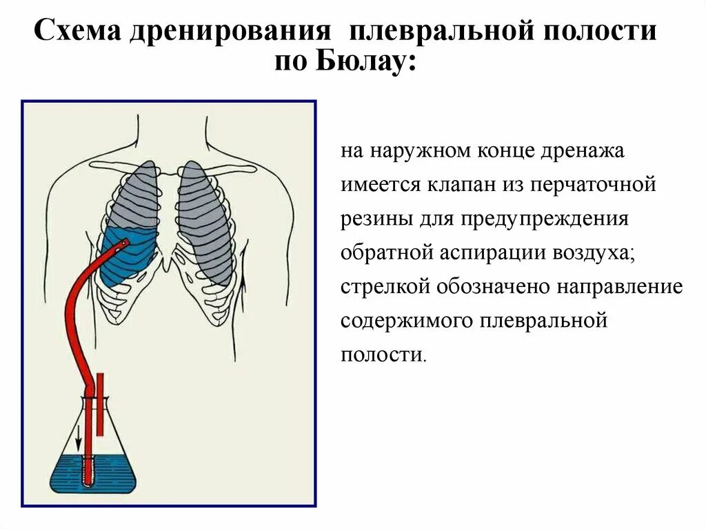 Лечение плевральной полости. Дренирование плевральной полости 2 межреберье. Показания к дренирование плевральной полости гидроторакс. Пункция по Бюлау при пневмотораксе.