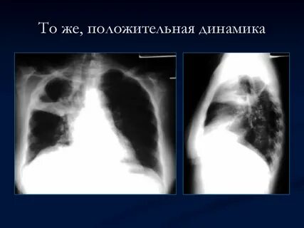 Туберкулез положительный