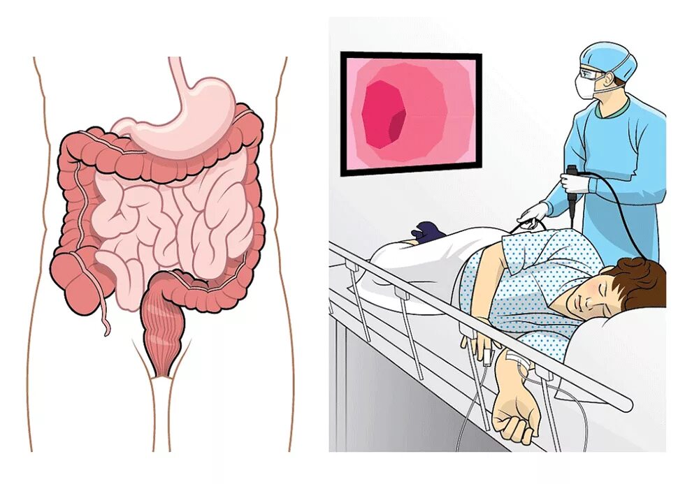 Ректальный врач. Биопсия колоноскопия толстой кишки. Эндоскопическое исследование толстой кишки колоноскопия. Эндоскопическое исследование Толстого кишечника. Колоноскопия Толстого кишечника.