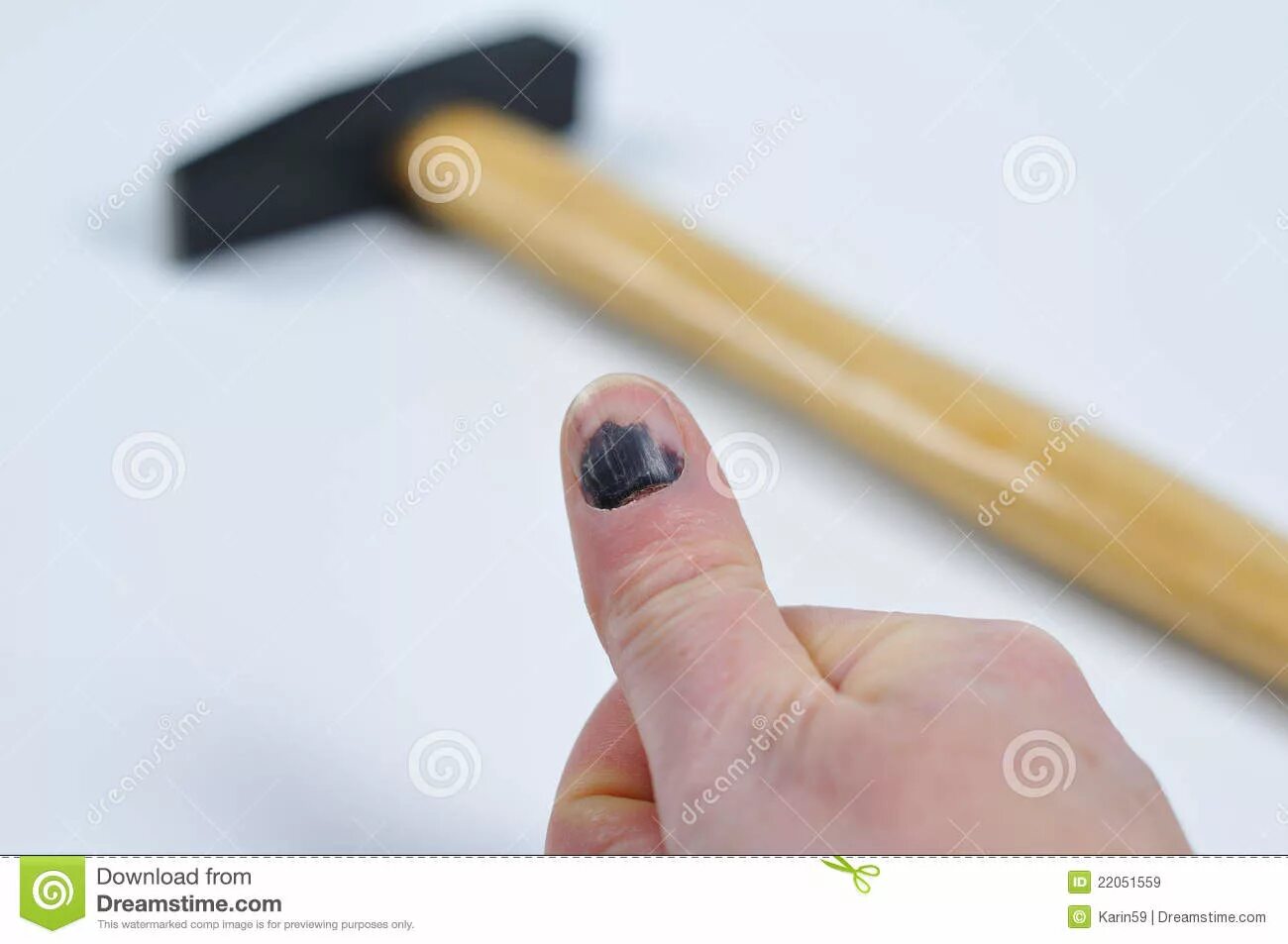 ударил молотком по пальцу. молотком по пальцу что делать. ударил молотком по пальцу. молотком по пальцу что делать. палец после удара молотком.