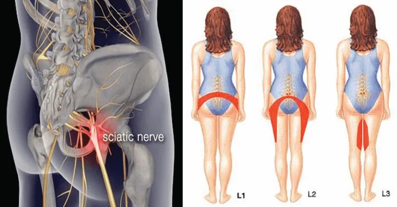 Бедра женщины фото где находится. Растяжка седалищного нерва. Тянущие боли в пояснице крестце. Локализация боли в крестце.