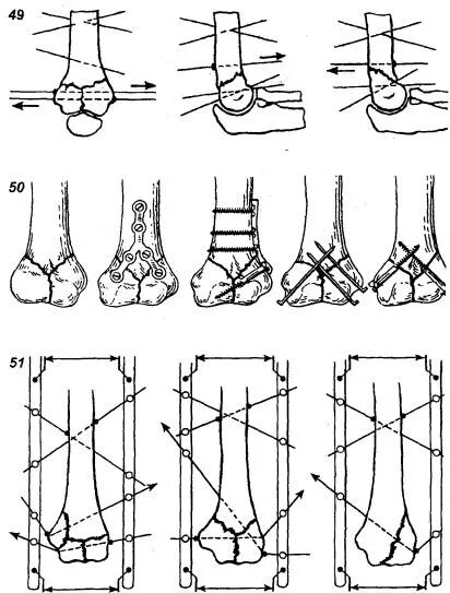 Остеосинтез мыщелков. Перелом мыщелка остеосинтез. Перелом плечевой кости накостный остеосинтез. Остеосинтез наружного мыщелка плечевой кости. Перелом мыщелков плечевой кости остеосинтез.