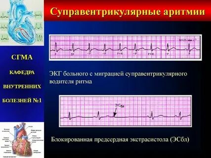Наджелудочковый гребешок у взрослого