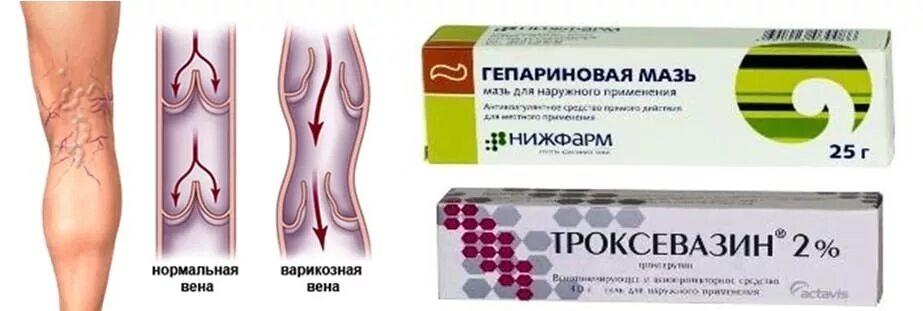 Атеросклероз нижних конечностей лечение препараты мази. Эффективная мазь от расширения вен. мазь от варикоза вен на ногах. препараты от венозного расширения вен на ногах.