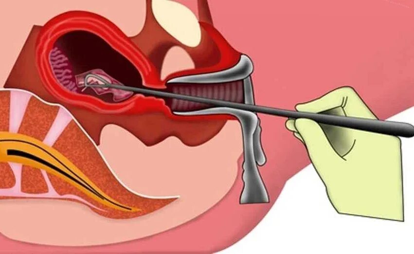 Кровь в полости матки. Раздельное диагностическое выскабливание полости матки. Раздельное диагностическое выскабливание слизистой оболочки матки. Хирургическое выскабливание полости матки.