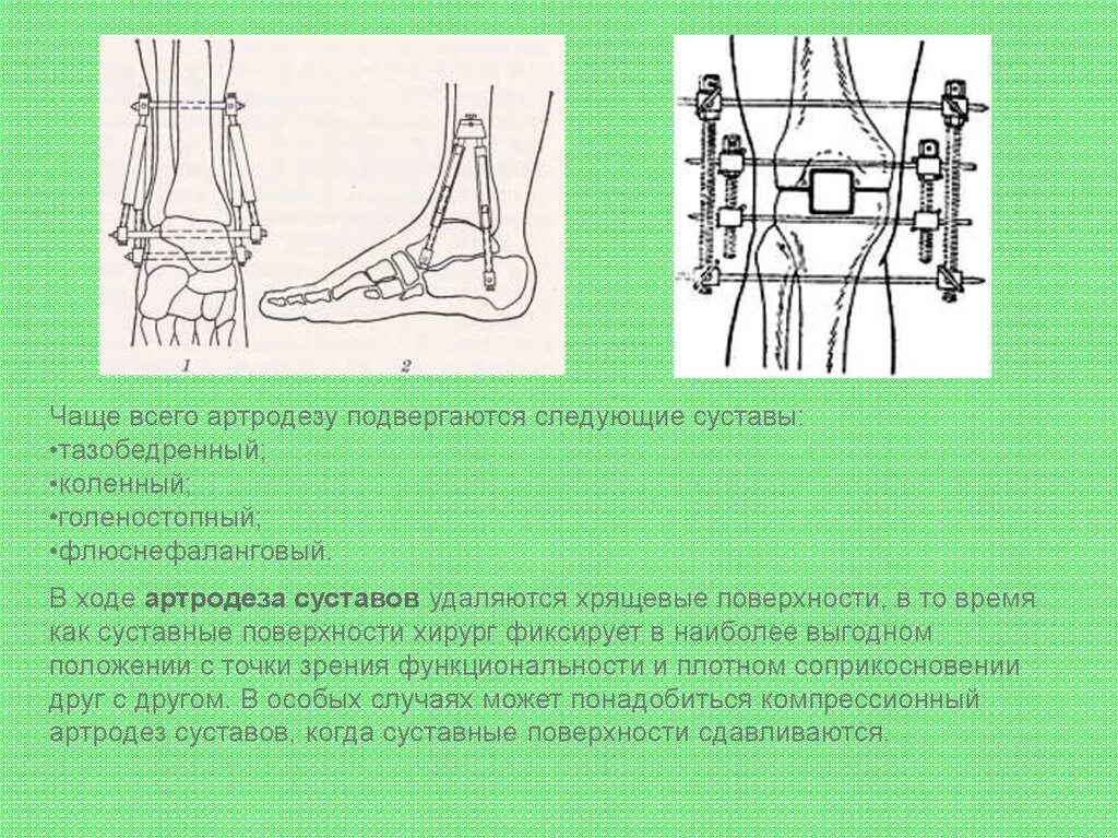 Артродез суставов операция. Внесуставной артродез. Артродез коленного сустава топографическая анатомия. Операция артродеза тазобедренного сустава.. Артродез плечевого сустава операция.