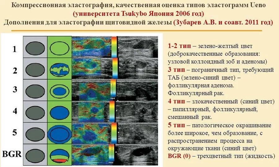 Эластография щитовидной железы что это. Соноэластография ультразвуковая эластография. Магнитно-резонансная эластография. Протокол компрессионной эластографии печени. Компрессионная эластография щитовидной железы.