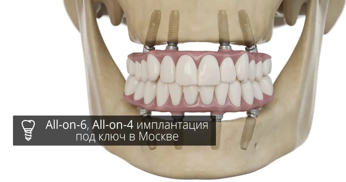 Имплантация зубов по технологии «all on 4». НОВАДЕНТ имплантация под ключ. All on 6 имплантация под ключ.