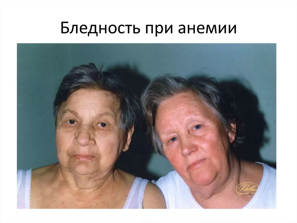 Кожные покровы при железодефицитной. Кожные покровы при железодефицитной