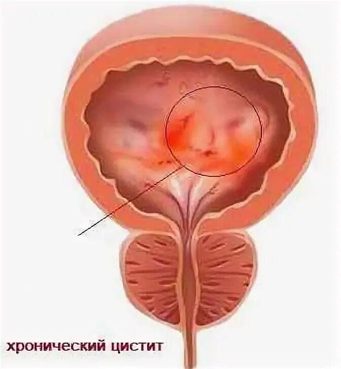 Циститы после близости. Цистоскопия при хроническом цистите.