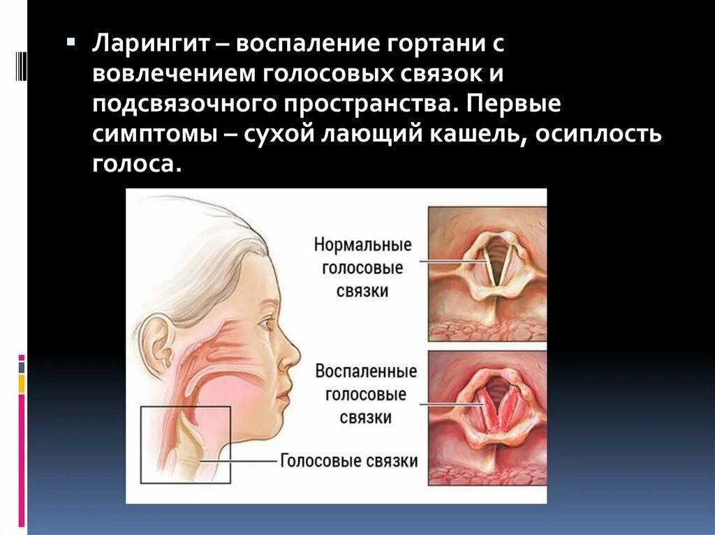 Лечение голосовых