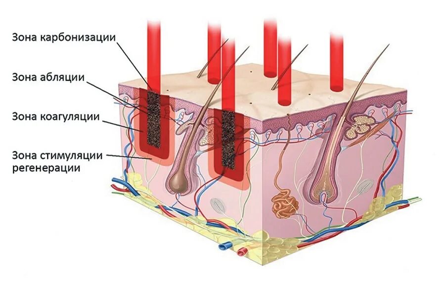 Лазерное воздействие на кожу skinlift ru. Фракционный абляционный лазер co2. Фракционный лазер со2 аппарат. Фракционный фототермолиз со2. Абляционный фракционный термолиз кожи.