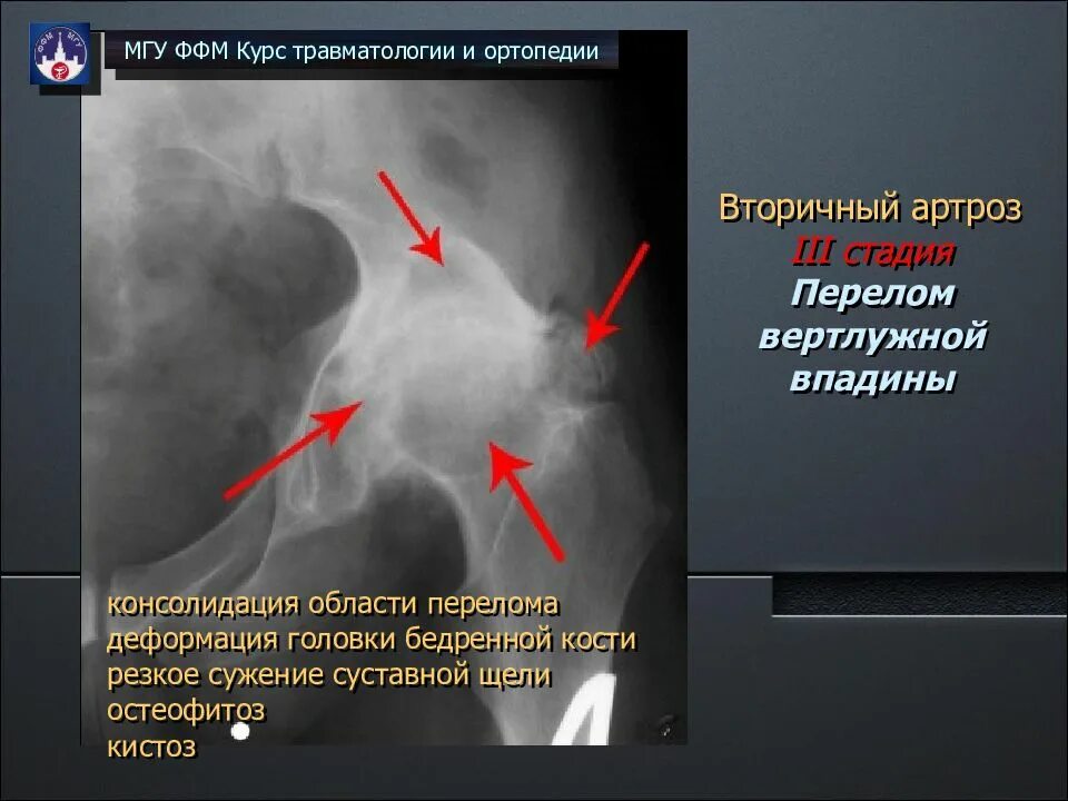 Что такое консолидация перелома. Асептический некроз вертлужной впадины рентген. Перелом вертлужной впадины тазобедренного сустава рентген. Асептический некроз вертлужной впадины и головки бедренной кости. Рентген асептический некроз бедренной кости.