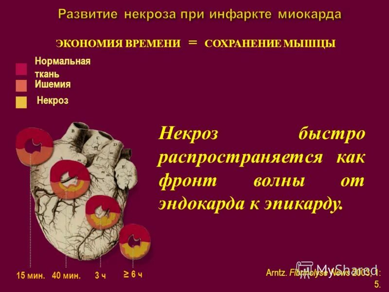 Чем отличается инфаркт от обширного инфаркта. Развитие некроза при инфаркте миокарда. инфаркт миокарда (некроз миокарда). памятка инфаркт миокарда. при остром инфаркте миокарда развивается.
