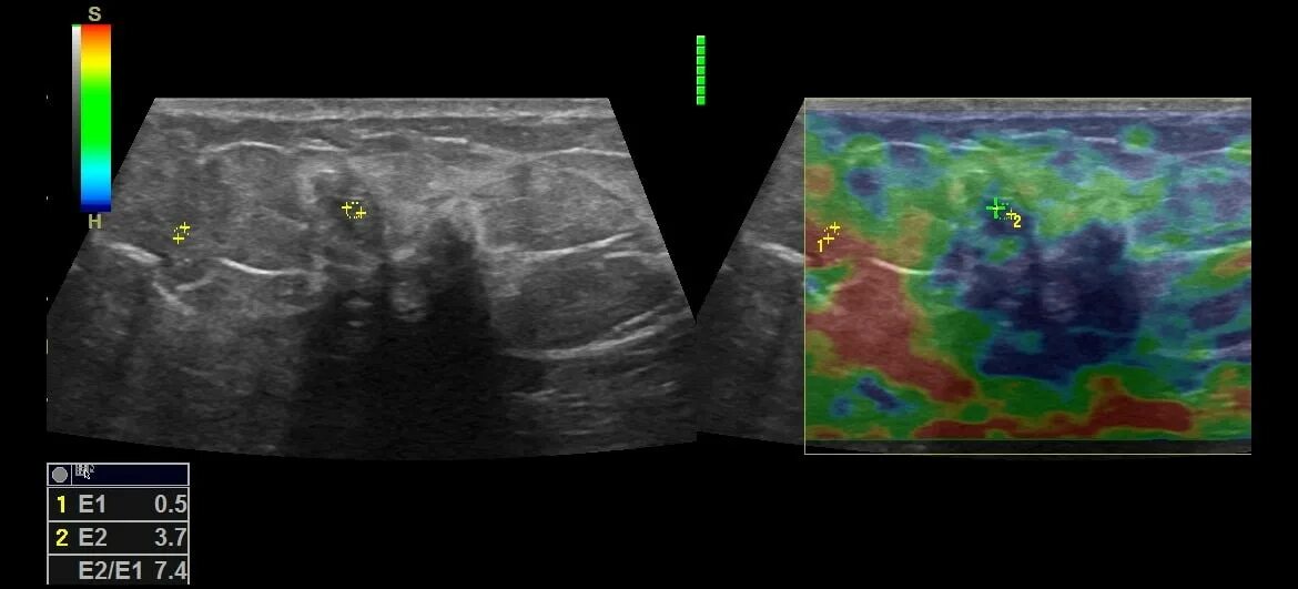 Эластография щитовидной железы что это. Соноэластография ультразвуковая эластография. Ультразвуковая компрессионная эластография. Магнитно-резонансная эластография. Ультразвуковая эластография молочной железы.